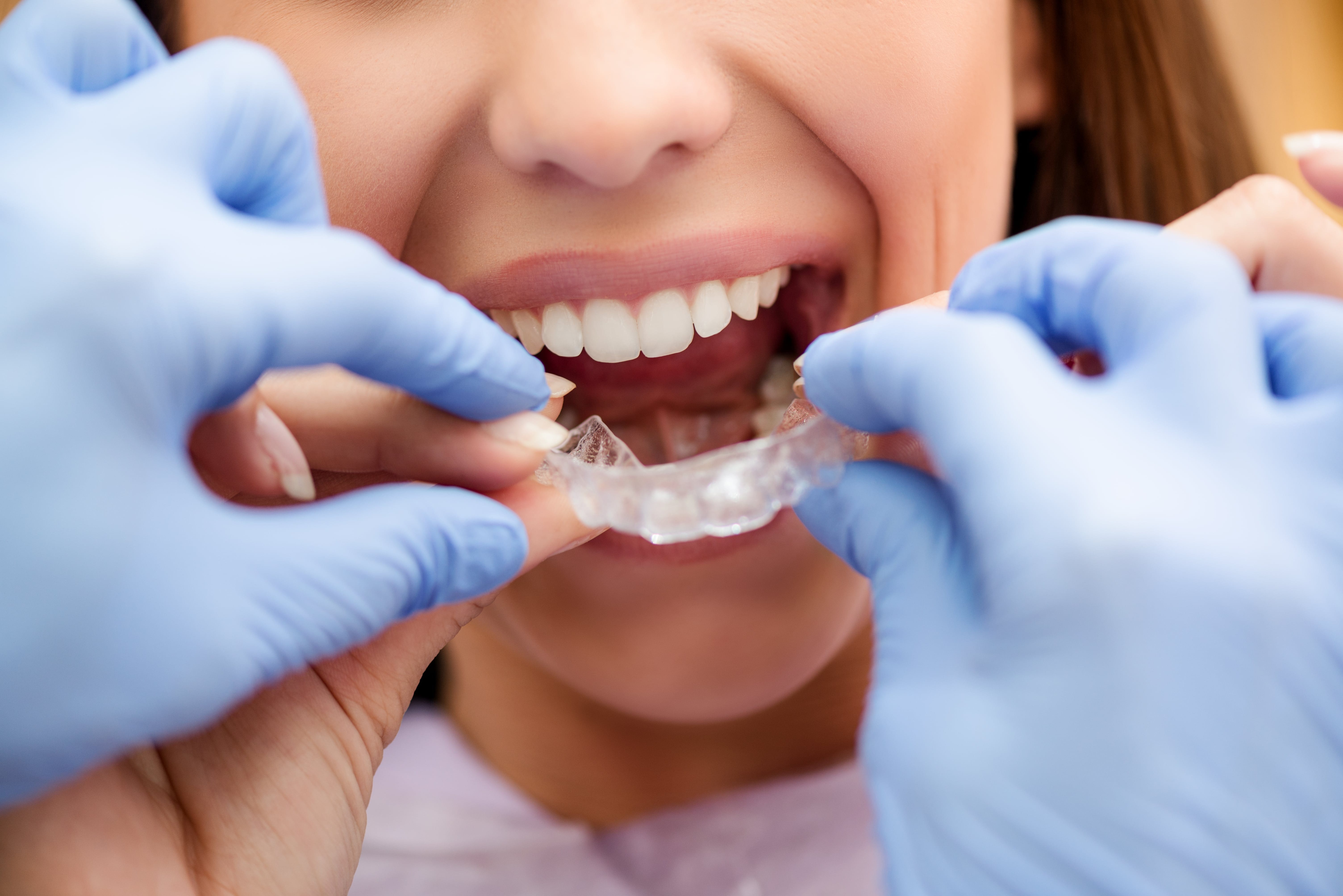 invisible braces P7RJ6FD min