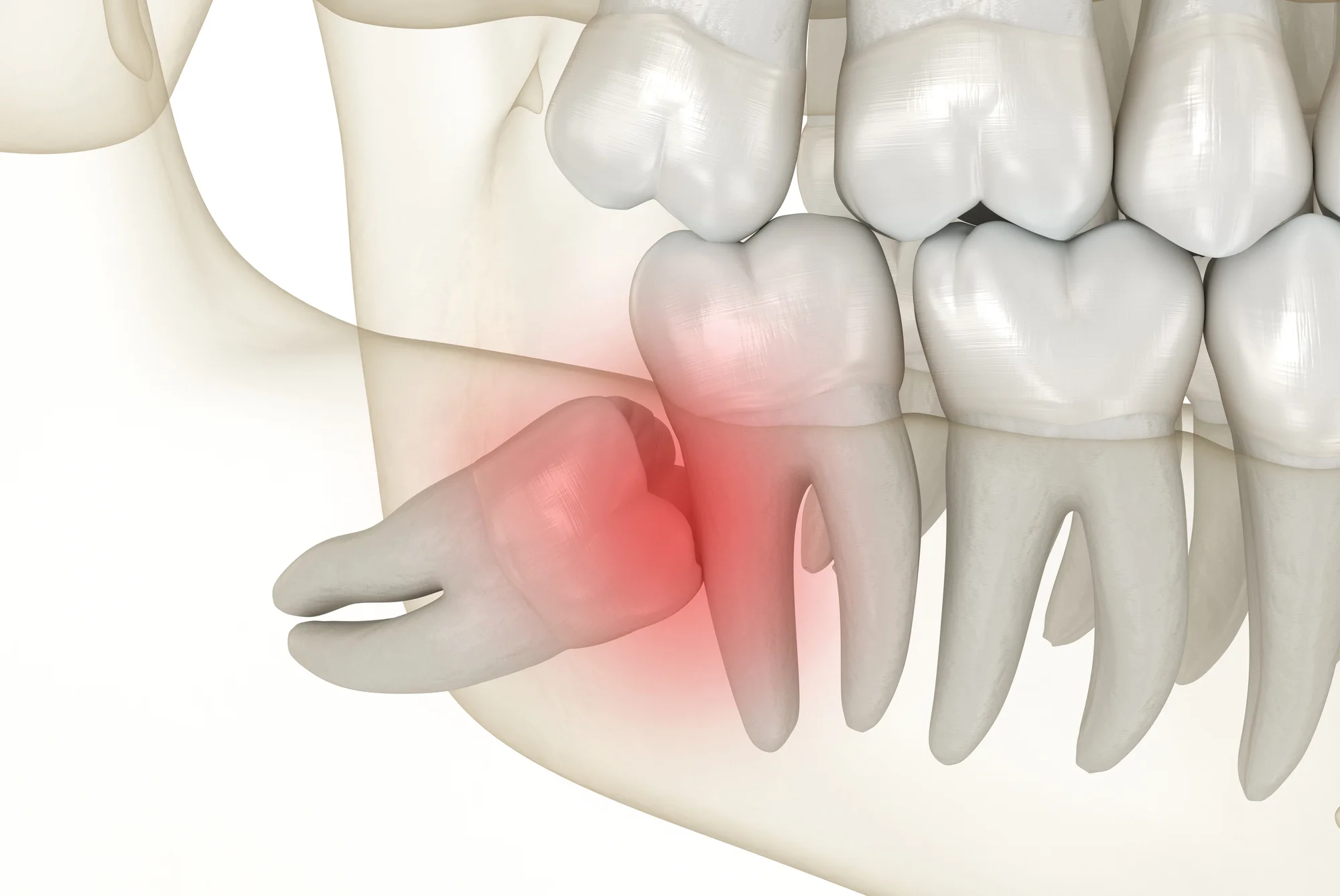 Mesial impaction of Wisdom teeth. Medically accurate tooth 3D illustration