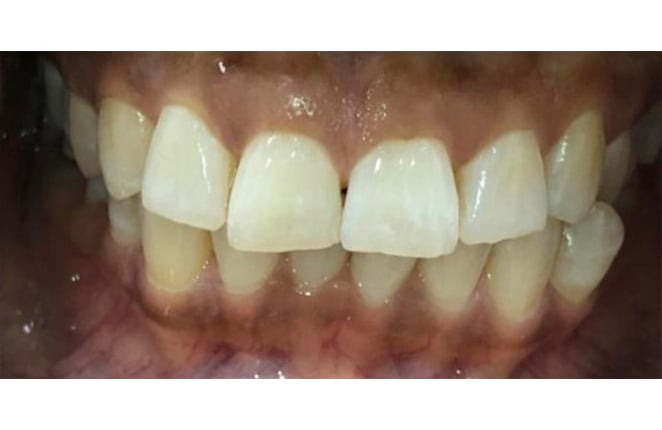 teeth whitening huntersville nc