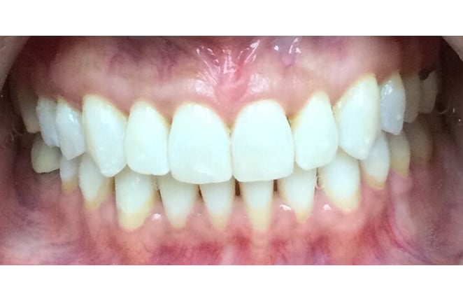 teeth whitening dentistry nc