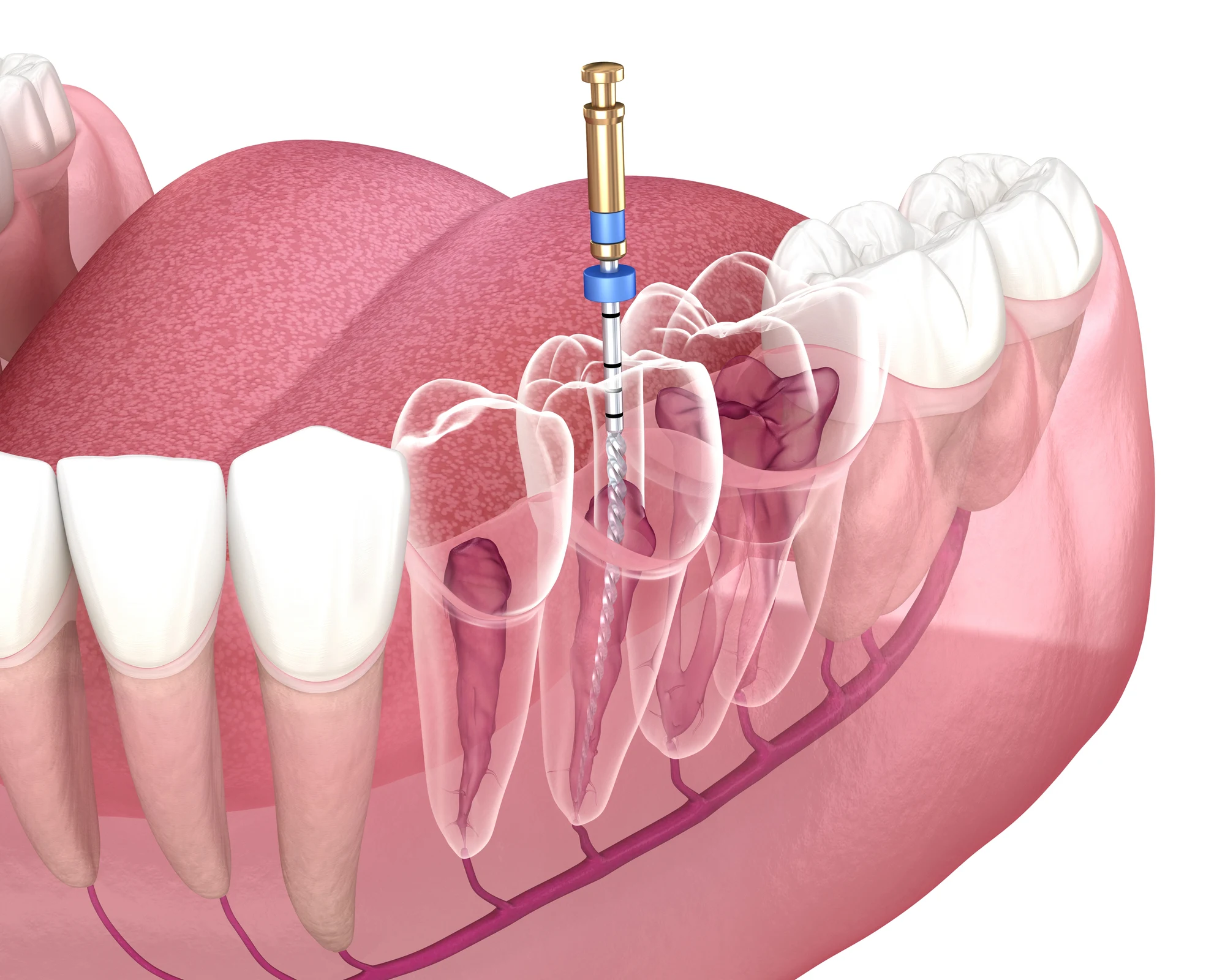 All about root canal treatment in Huntersville, NC