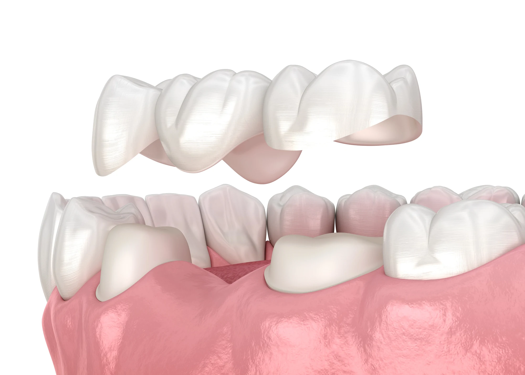 Choosing dental bridges in Hickory, NC