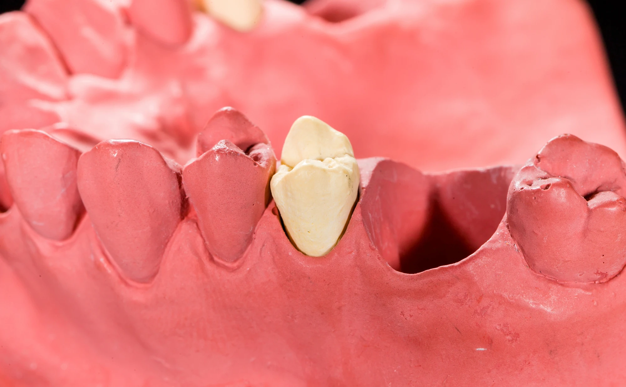 Do-you-need-a-dental-crowns-in-Harrisburg-NC