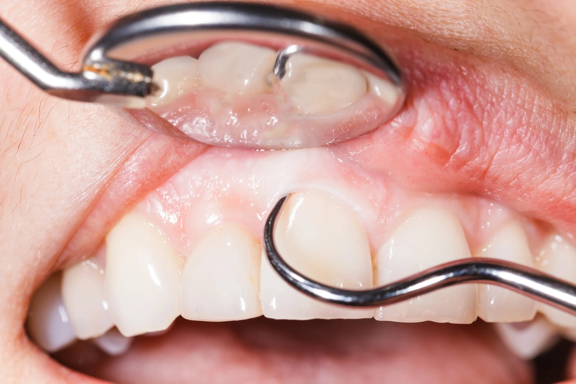 Gum-Check-by-a-dentist-in-28075