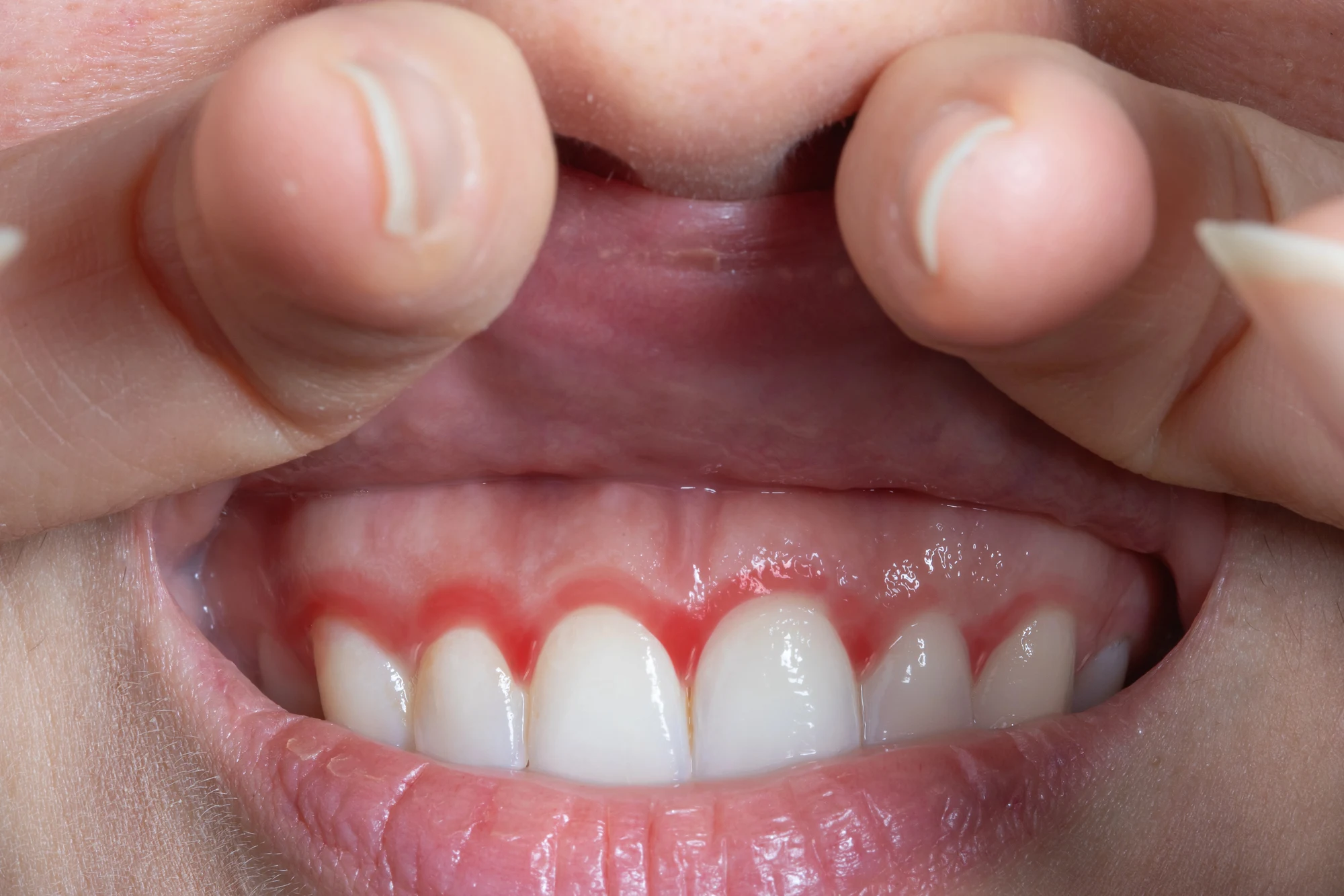Healthy gums with a help from a Dentist in Park Road