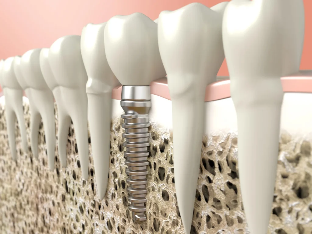 Implant-dentures-in-Harrisburg-NC