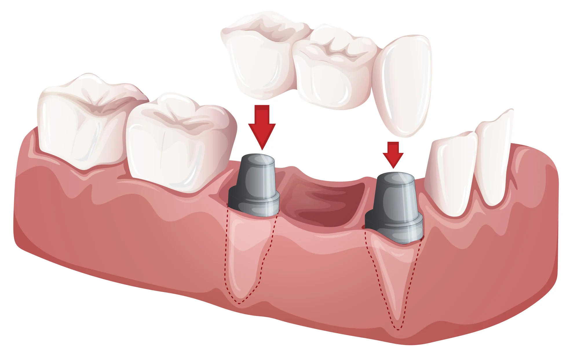 Other things about dental implants in Park Road, Charlotte, NC