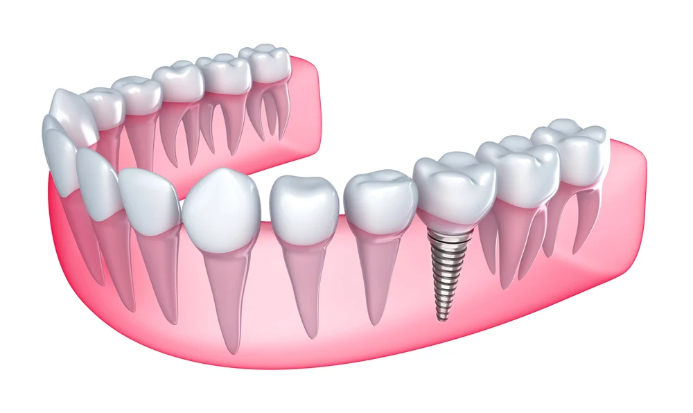 Your jaw and dental implants in Hickory, NC