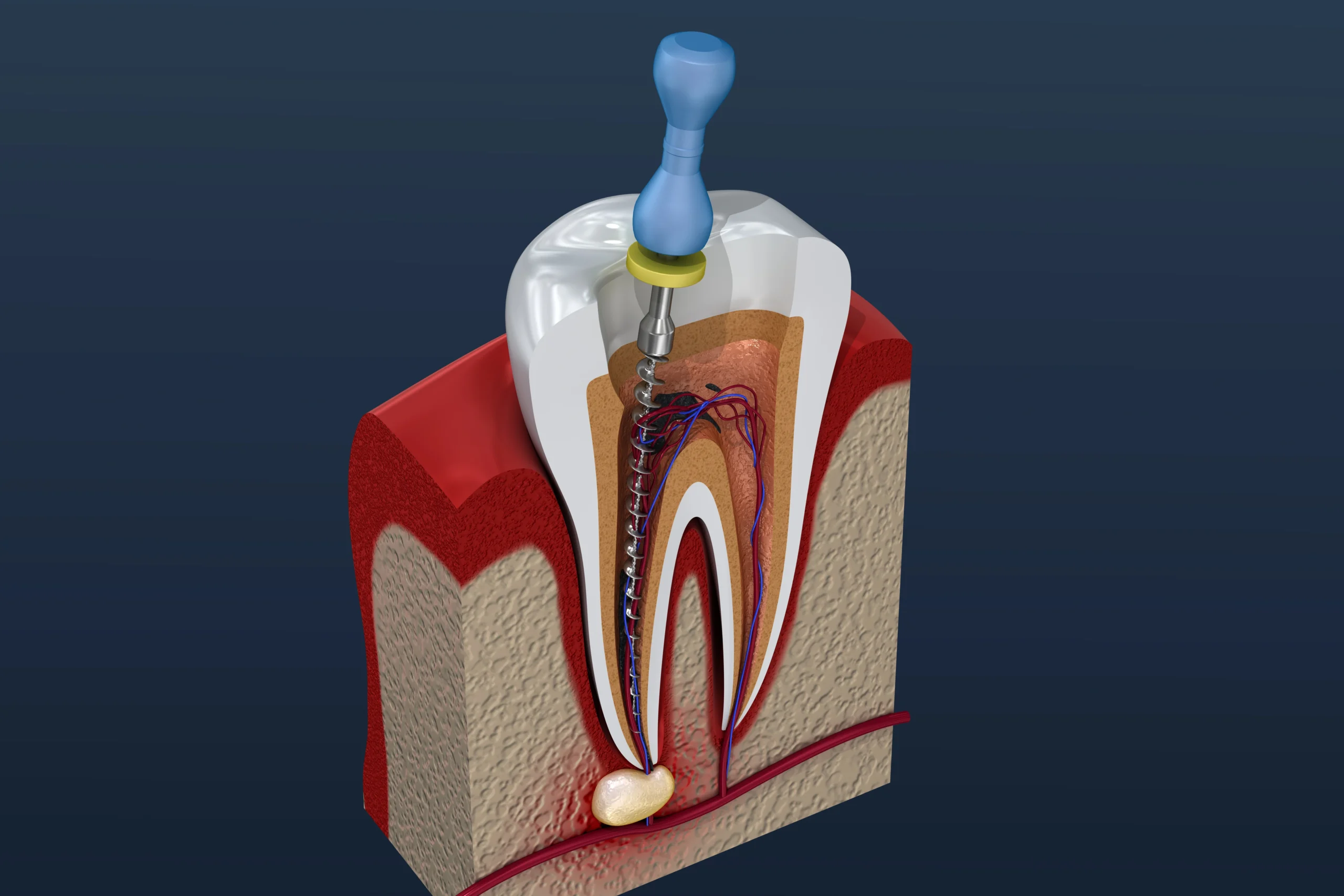 getting to the pulp through a root canal treatment