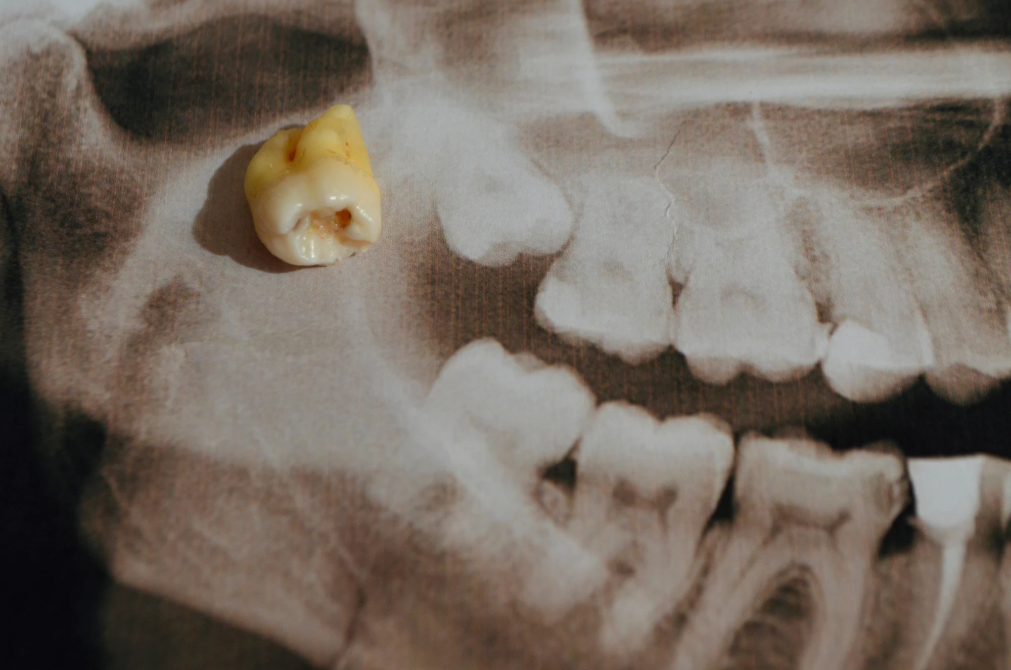 header photo of the need of Wisdom Tooth Extraction Surgery
