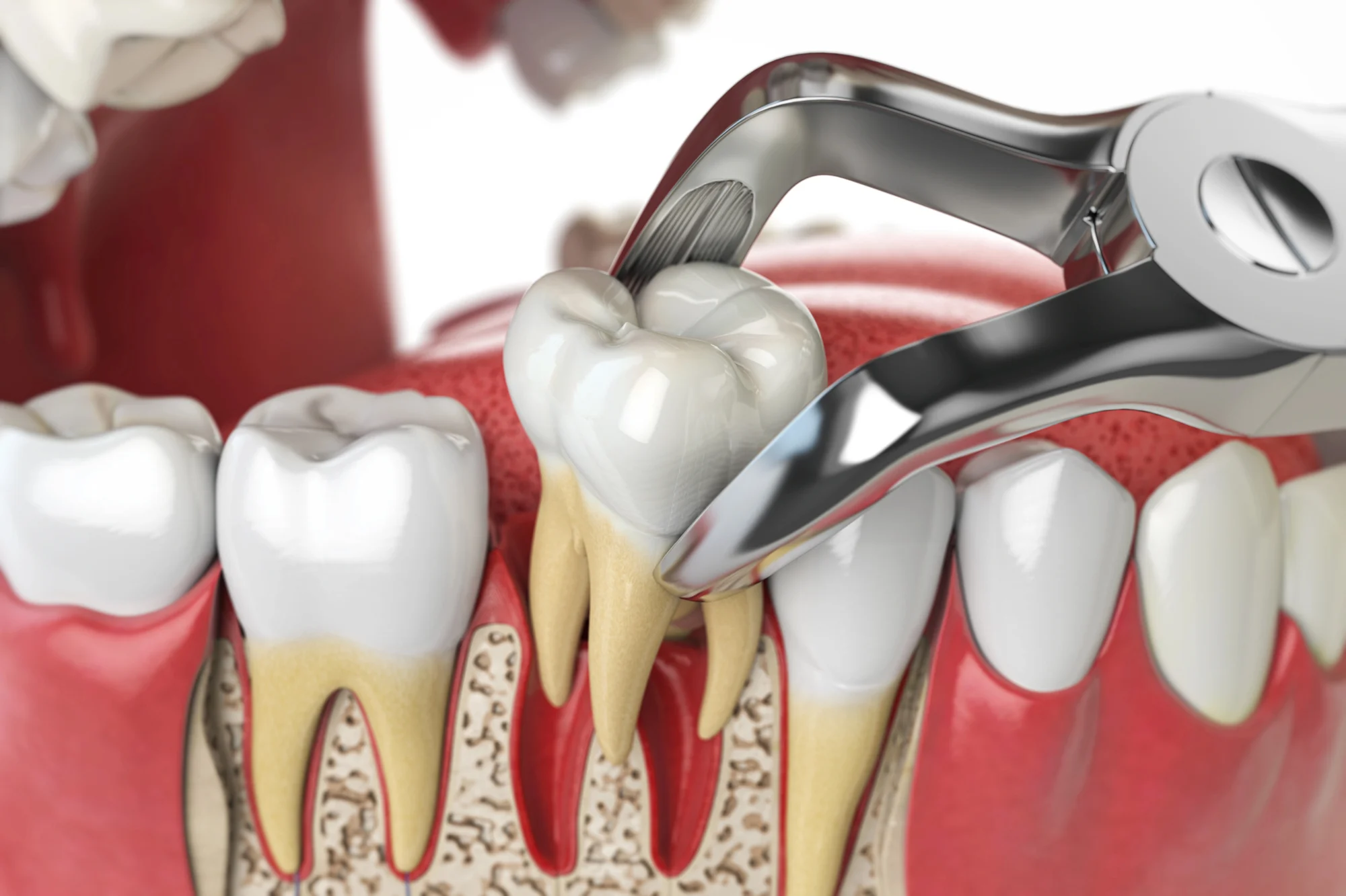 how tooth extraction is done