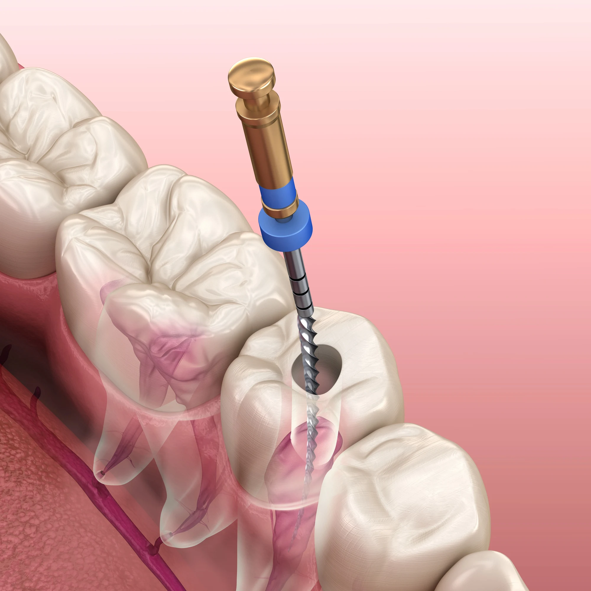 root canal treatment process