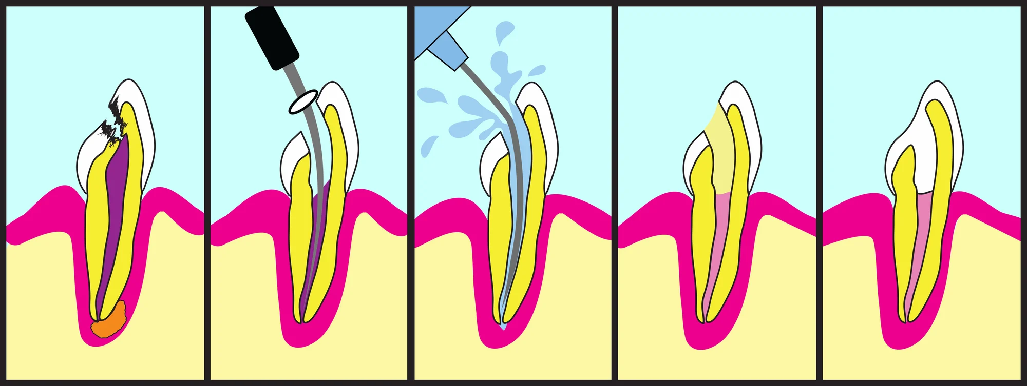 step-by-step procedure of root canal treatment