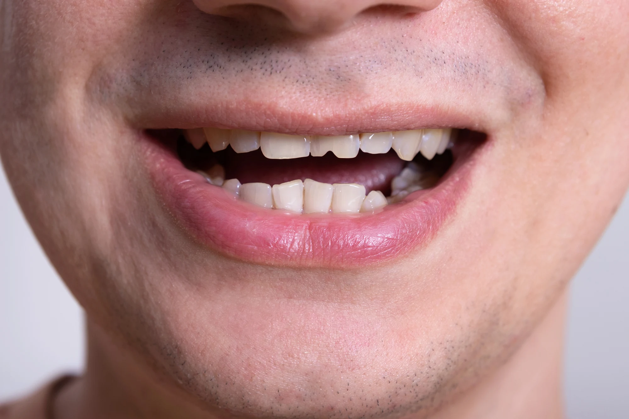 damaged tooth needing an emergency tooth extraction