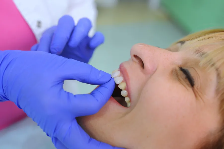 dentist-applying-veneers-concord-nc-to-patient-teeth