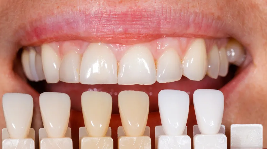 veneers-and-whitening-comparison