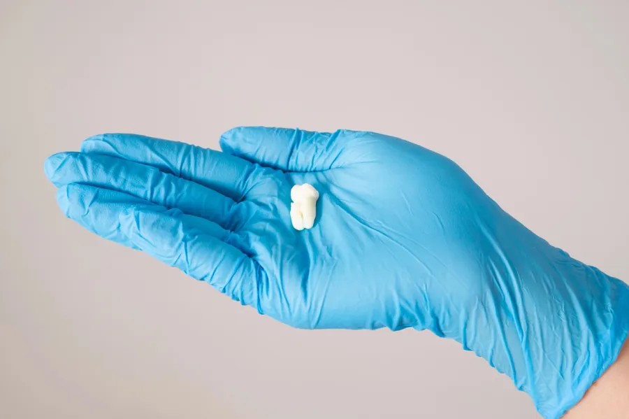wisdom tooth in hand glove patient dental surgery