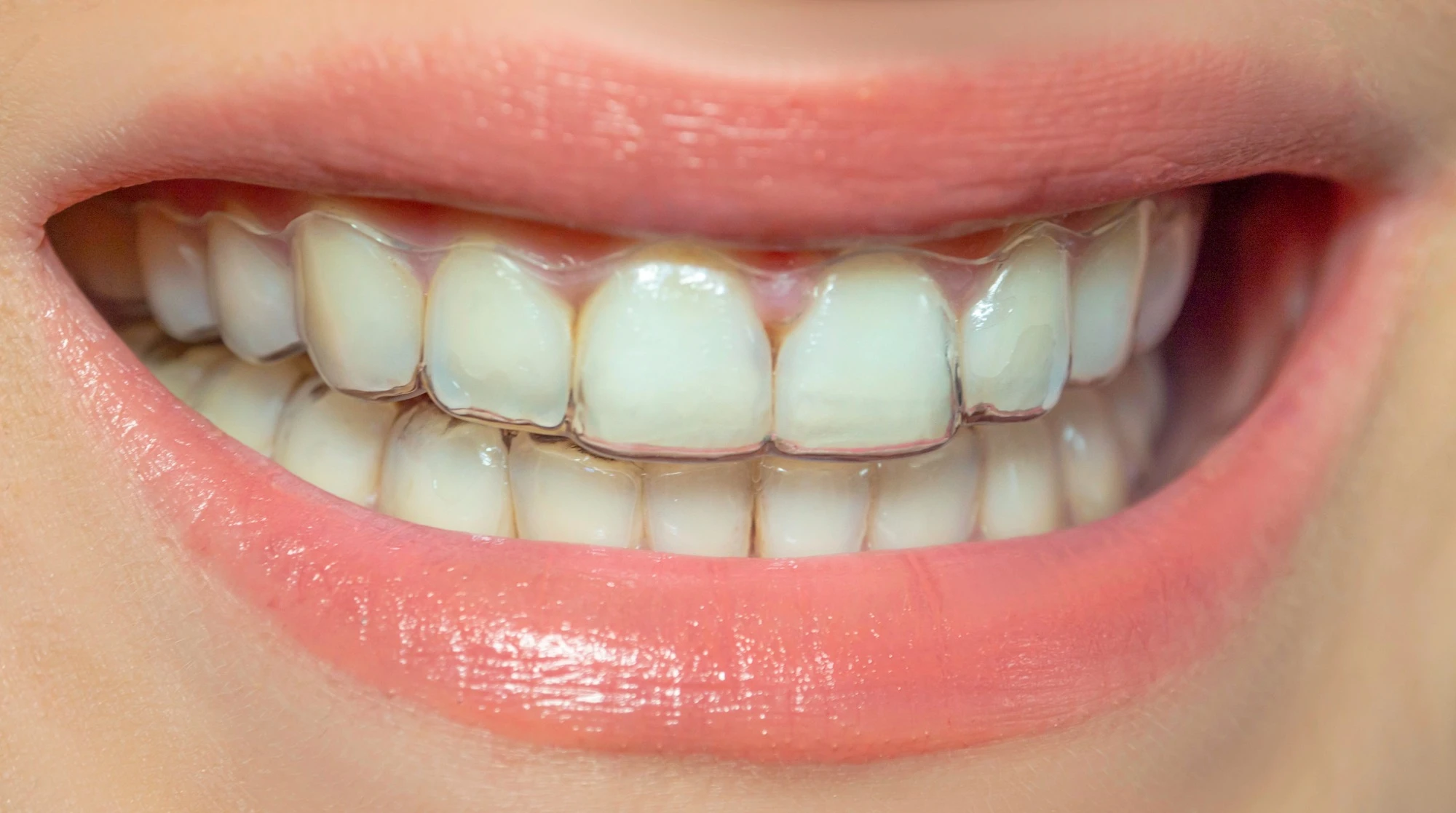 clear aligners gastonia invisible tray smile