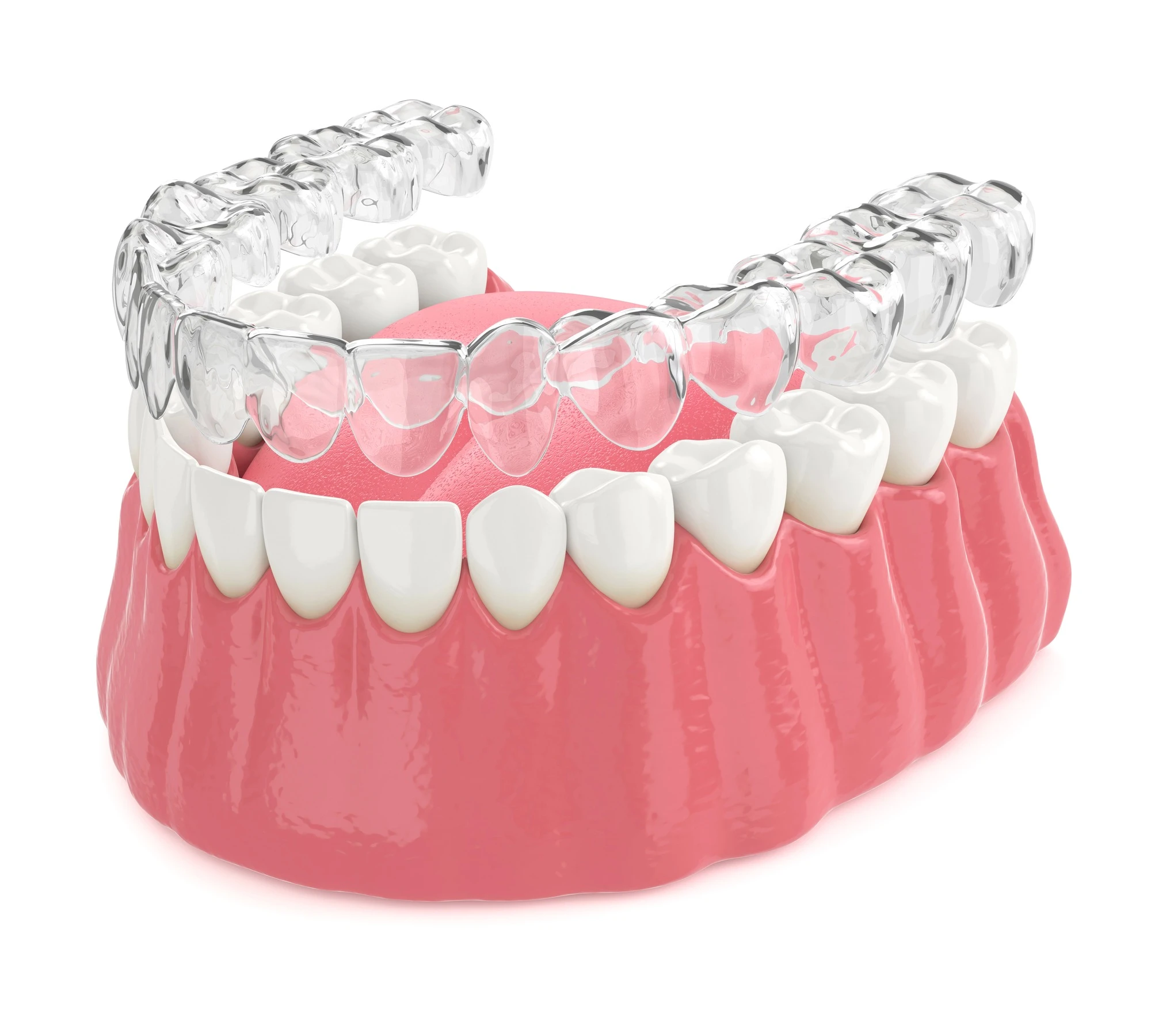 invisalign-huntersville-nc-clear-aligner-model