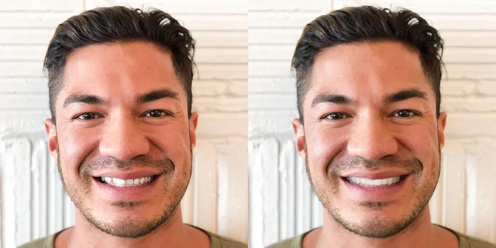 SmileView before and after 1