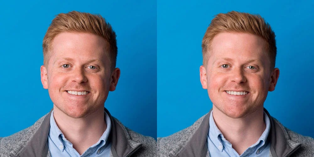 SmileView before and after 3