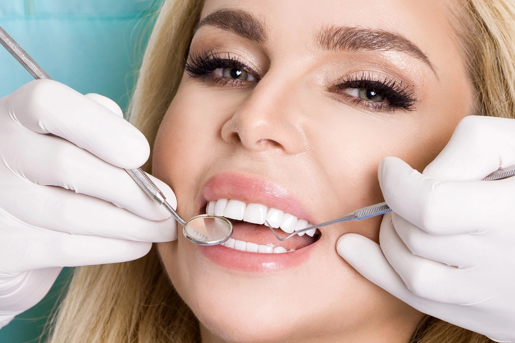 veneers-huntersville-nc-smile-transformation