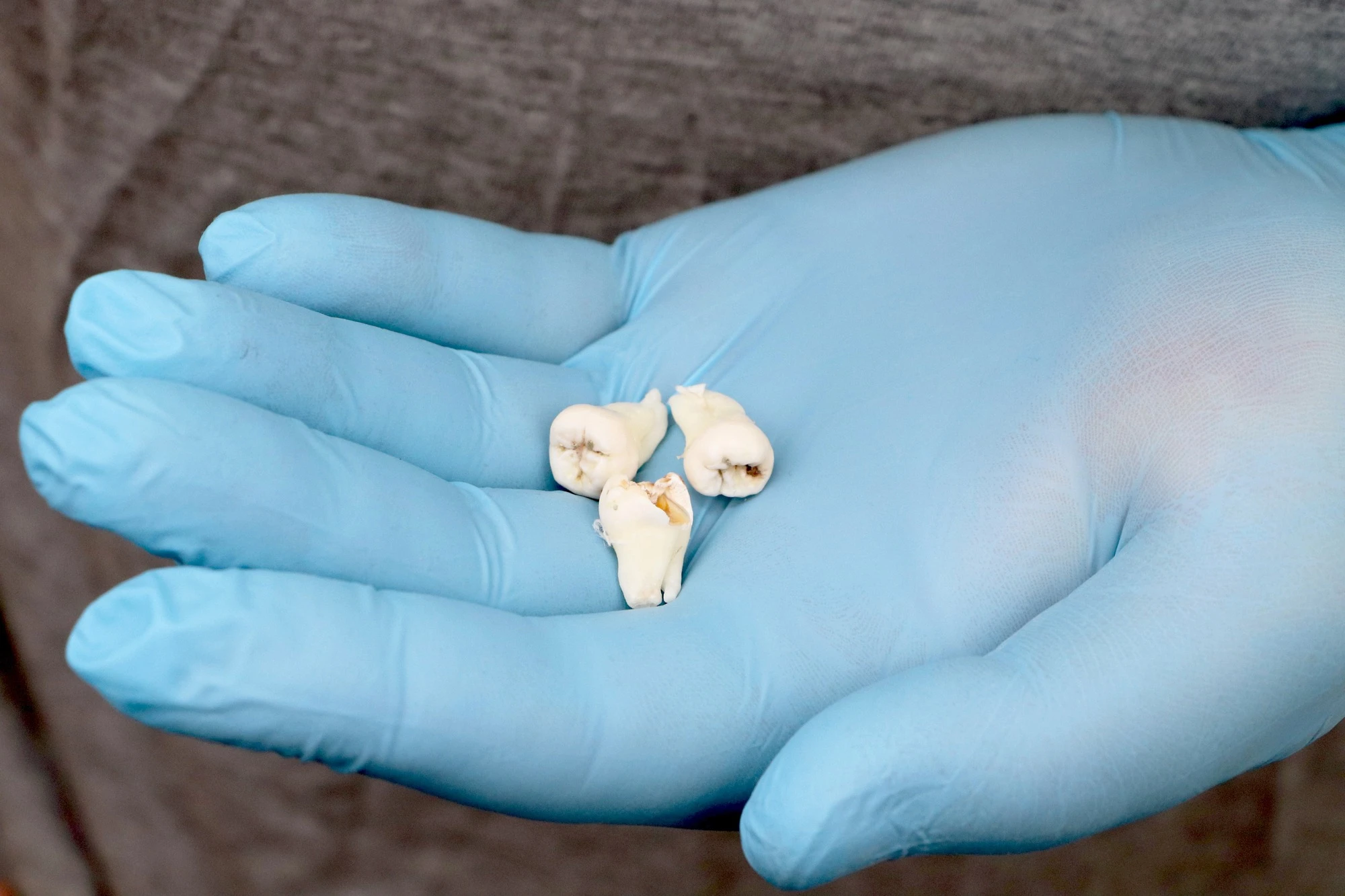 wisdom-teeth-removal-huntersville-nc-extracted-wisdom-teeth