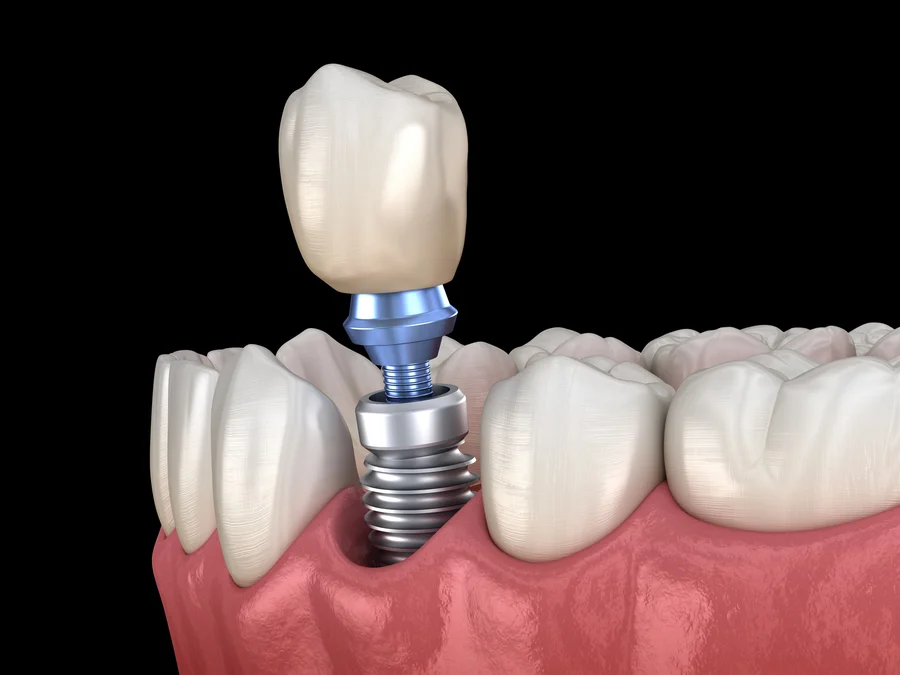 dental implants gastonia 3d model of implant supported bridge