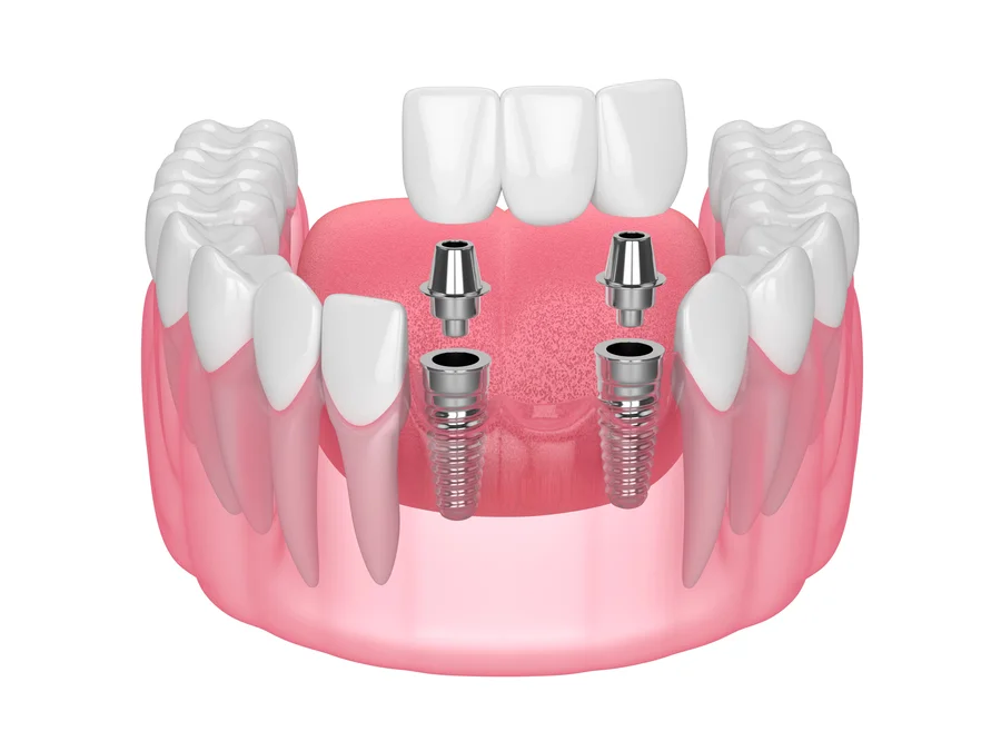 dental implants gastonia 3d model of implant supported bridge