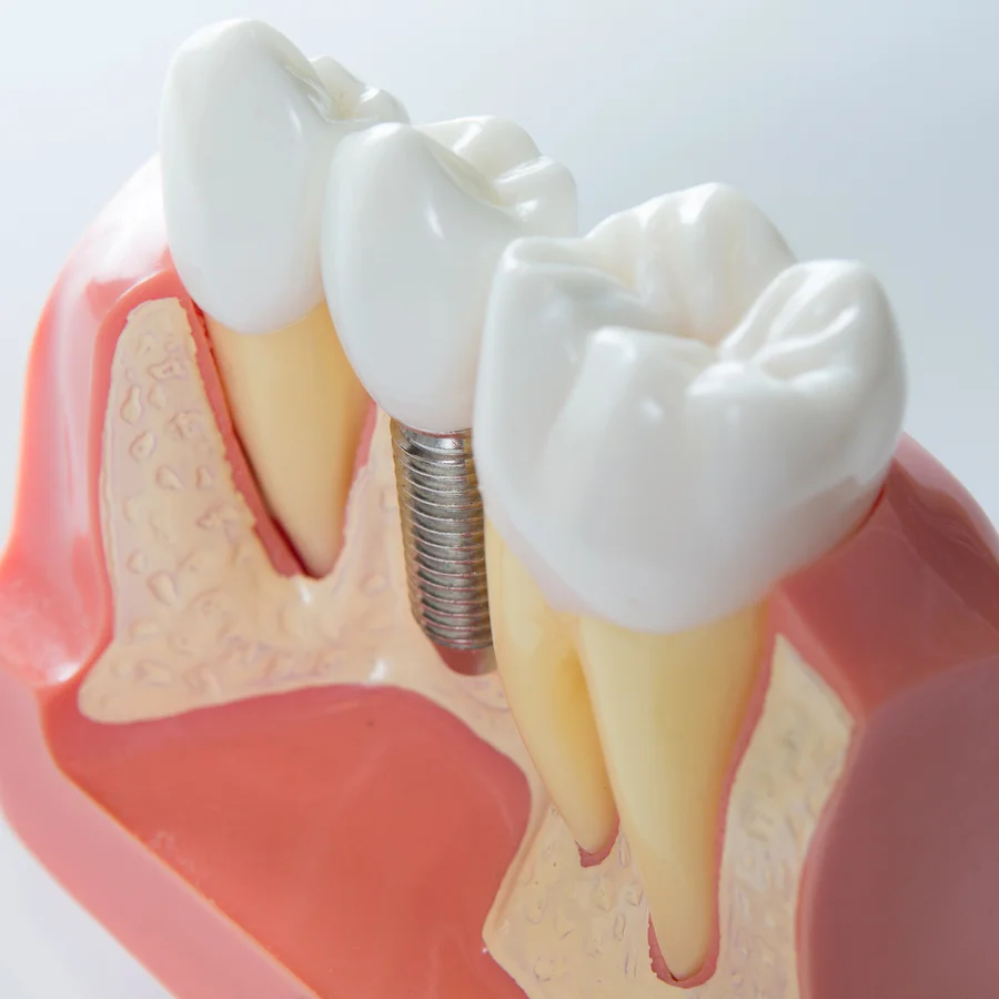 dental implants harrisburg closeup model of single tooth implant