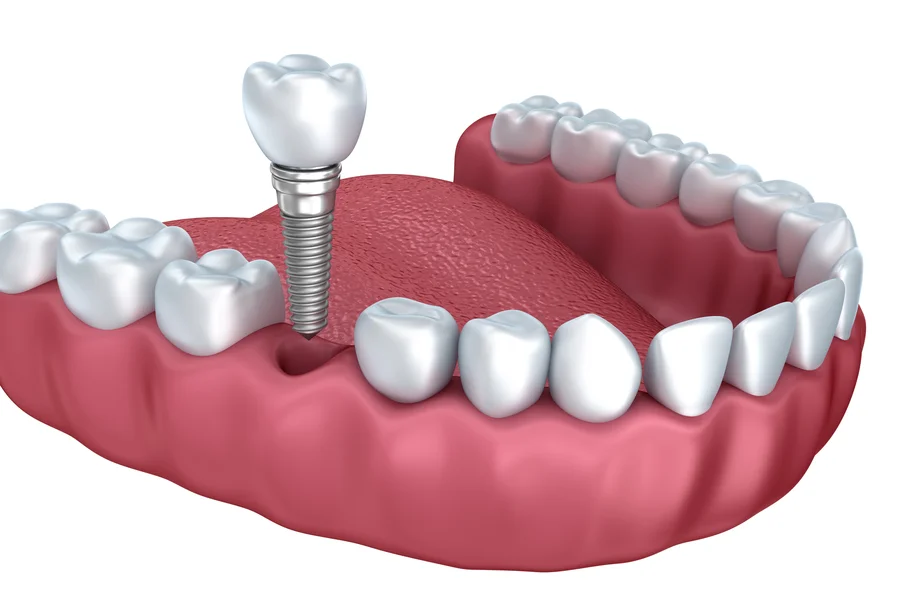 dental implants hickory nc 3d illustration of single implant in jaw