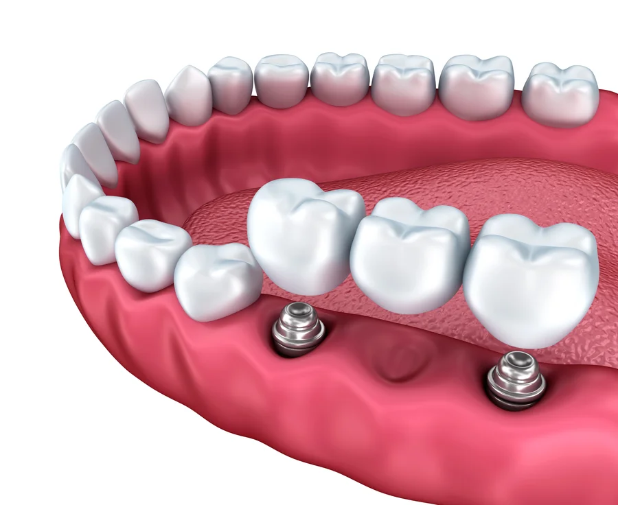 dental implants hickory nc illustration of implant supported molars