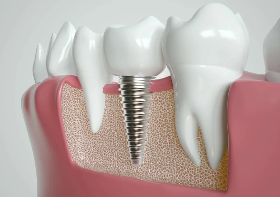 dental implants in huntersville nc 3d closeup of implant between teeth