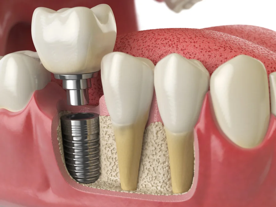 dental implants in huntersville nc cross section of implant in jawbone