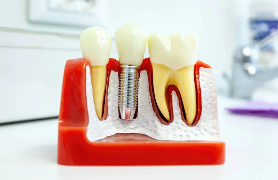 dental-implants-park-road-charlotte-nc-model-of-implant-between-teeth