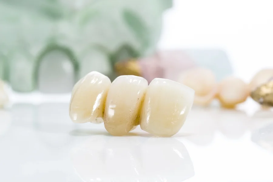 dental bridges hickory nc close up of three unit porcelain dental bridge