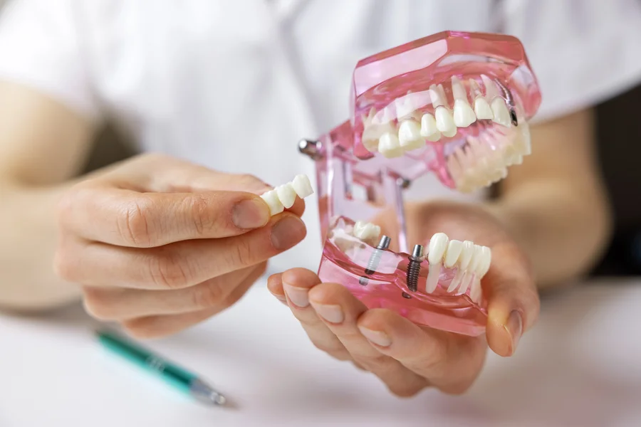 dental bridges hickory nc dentist showing bridge and implant jaw model