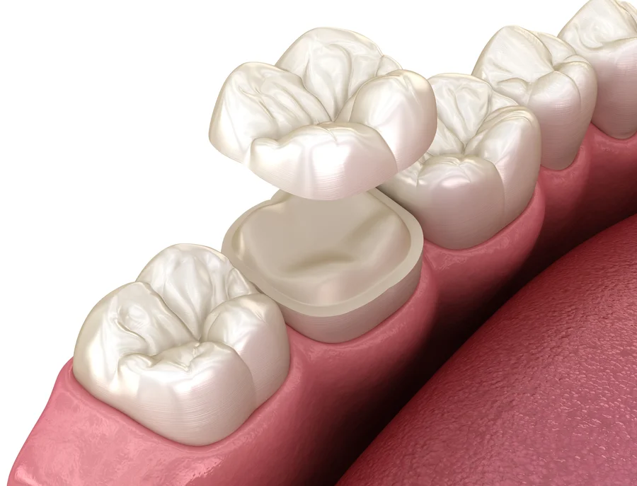 dental crowns harrisburg nc 3d model of crown above prepared molar