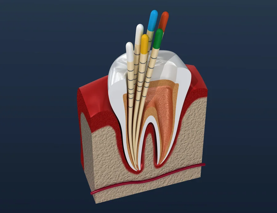 root canal treatment harrisburg nc 3d tooth cross section with endodontic files