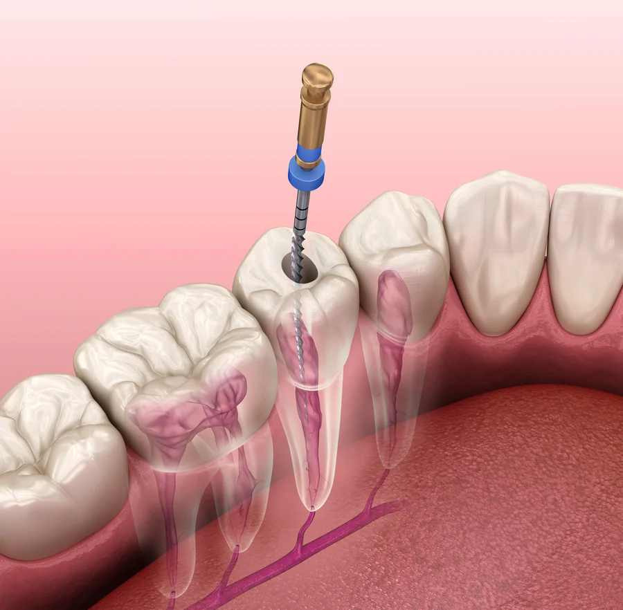 root canal treatment huntersville nc illustration of a file cleaning a tooth canal