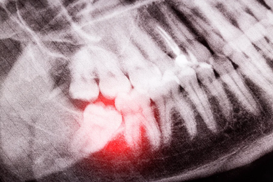 wisdom teeth removal charlotte nc panoramic x ray with painful impacted tooth in red